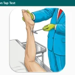 Achilles Tendon Tap Test