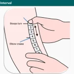 Biceps Crease Interval