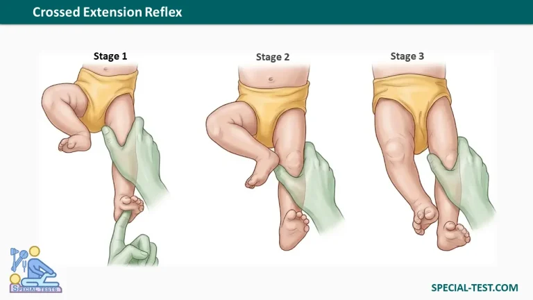 Crossed Extension Reflex