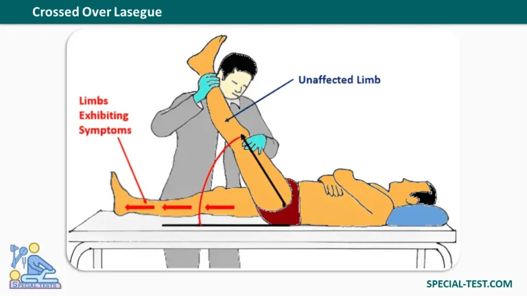 Crossed Over Lasegue test