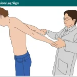Deltoid Extension Lag Sign
