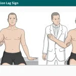 External Rotation Lag Sign