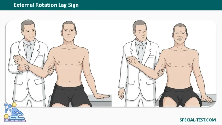 External Rotation Lag Sign