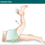 Femoral Nerve Stretch Test