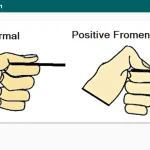 Froment’s sign