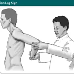 Internal Rotation Lag Sign