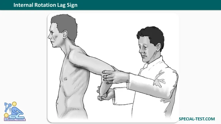 Internal Rotation Lag Sign