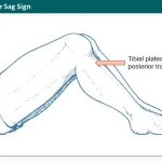 Posterior Sag Sign