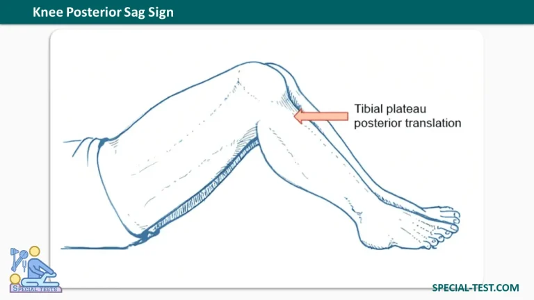 Knee Posterior Sag Sign
