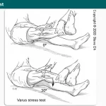 Knee Varus Test