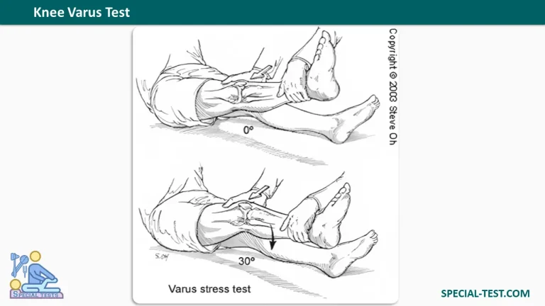Knee Varus Test