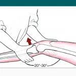 Lachman Test