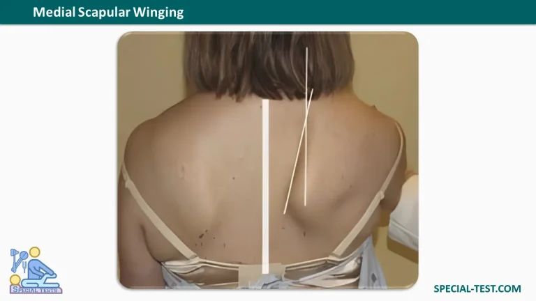 Medial Scapular Winging