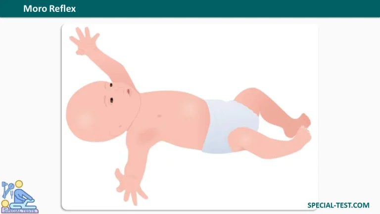 Moro Reflex