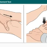 Patellar Ballottement Test