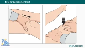Patellar Ballottement Test (Patellar Tap Test)