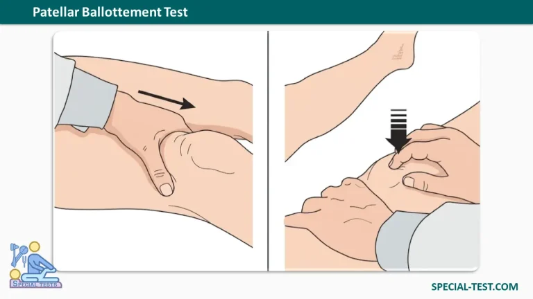 Patellar Ballottement Test