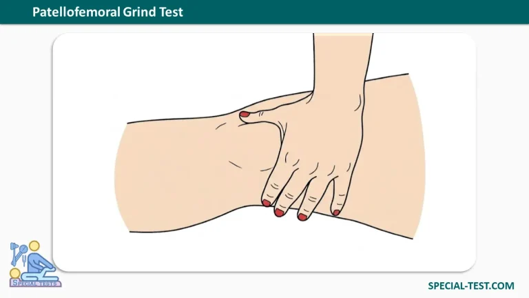 Patellofemoral Grind Test