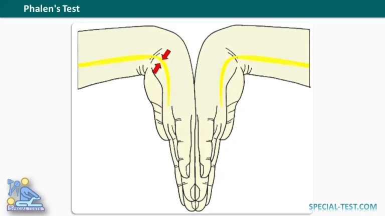 Phalens Test