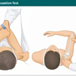 Posterior Subluxation Test
