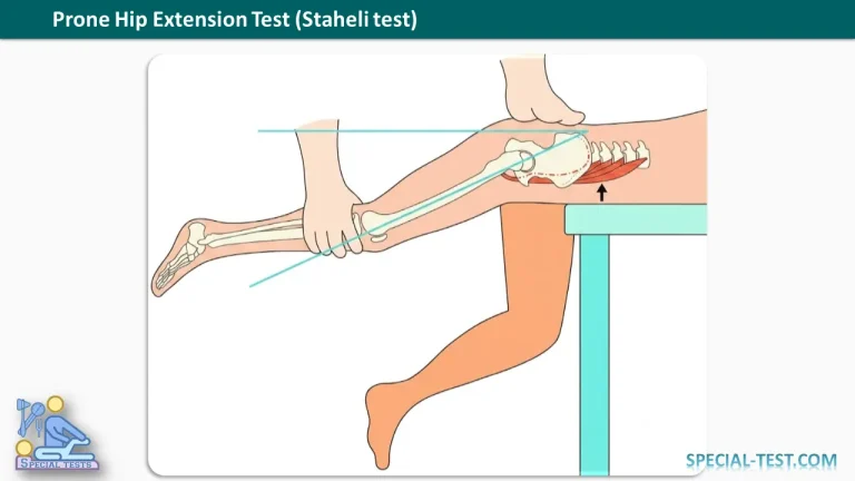 Prone Hip Extension Test Staheli test