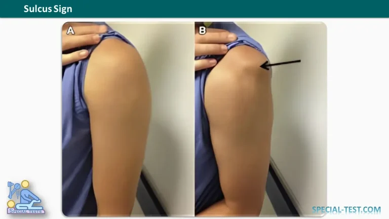 Sulcus Sign
