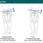 Trendelenburgs Test